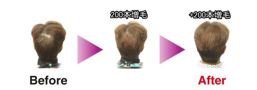 ミュークス＆さんわ増毛フェルモ